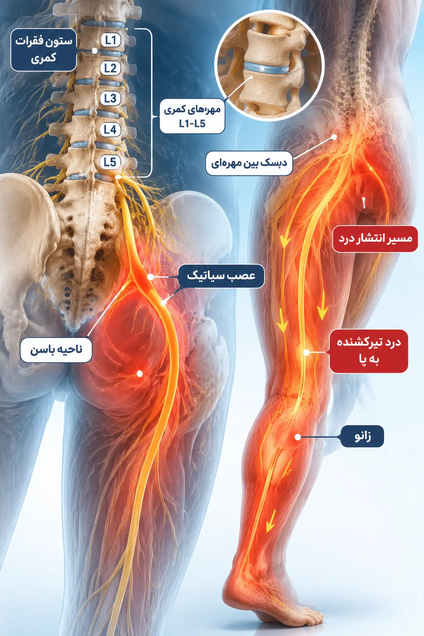 symptoms.webp	انتشار درد فتق دیسک کمر به پا